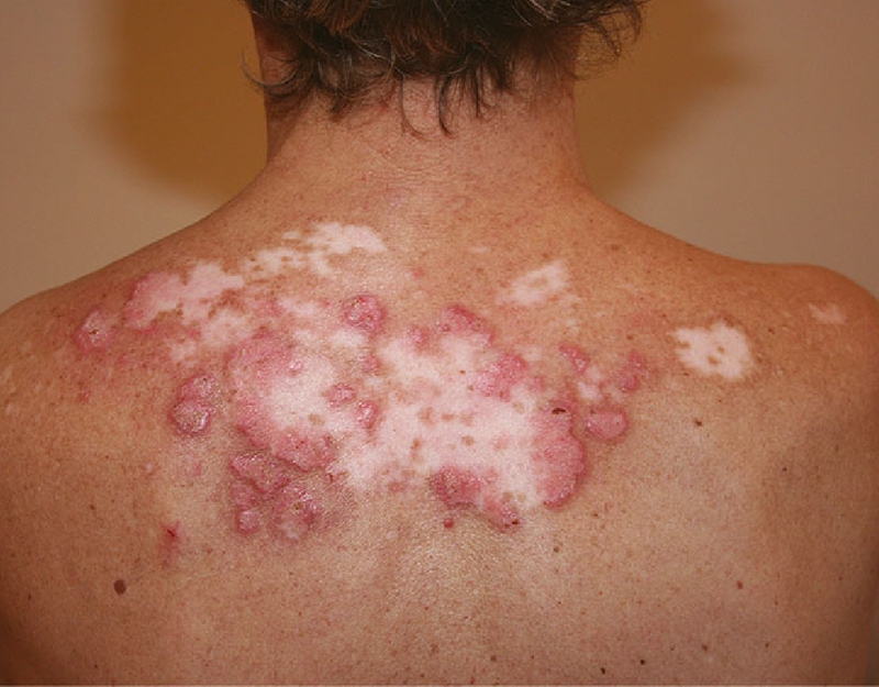 Lupus ban đỏ mãn tính: Nguyên nhân, triệu chứng và cách điều trị 3