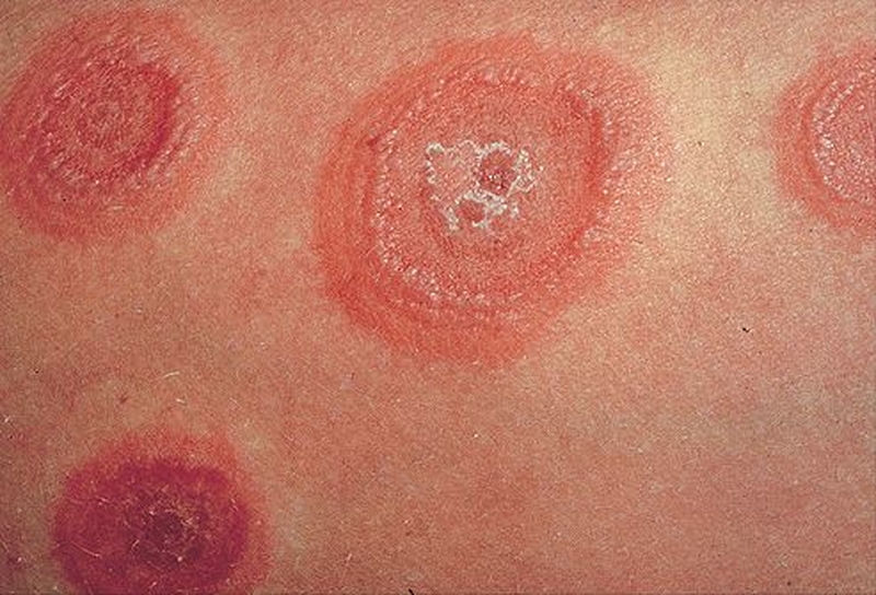 Lupus ban đỏ ở chân: Triệu chứng, nguyên nhân và phương pháp chữa trị 2