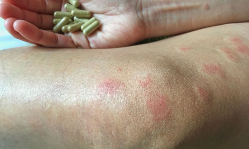 Lupus ban đỏ ở chân: Triệu chứng, nguyên nhân và phương pháp chữa trị 3