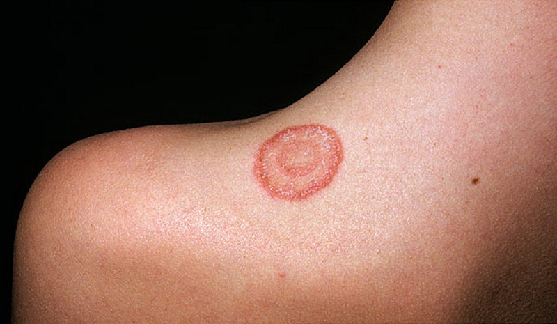 lupus ban đỏ ở cổ có nguy hiểm không?