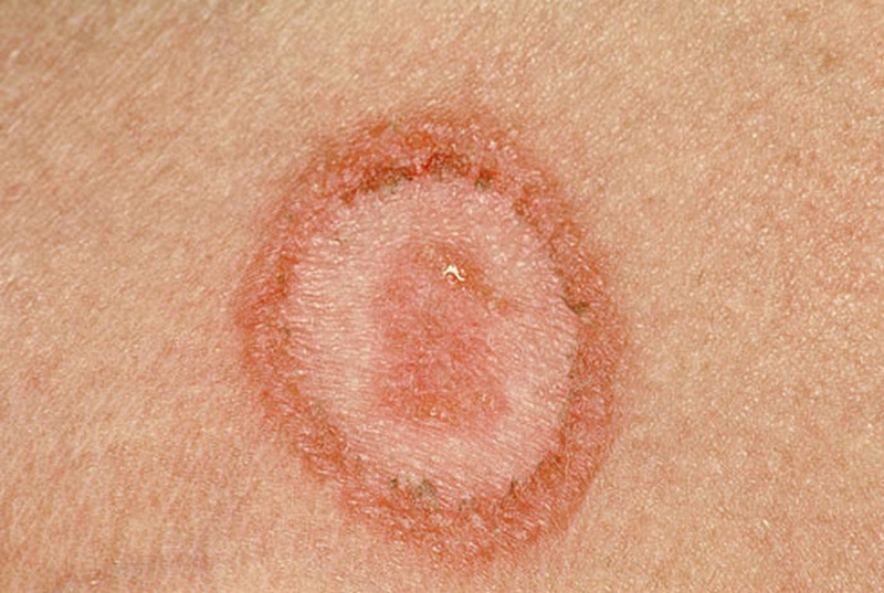 lupus ban đỏ ở cổ có nguy hiểm không? 3