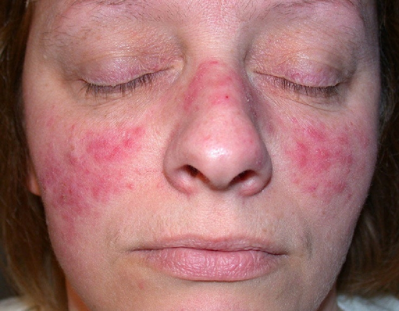 Lupus ban đỏ và bệnh tự miễn có khác nhau không? 3