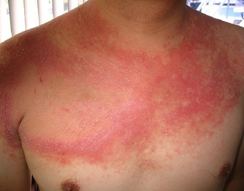 Lupus ban đỏ và bệnh tự miễn có khác nhau không? 4