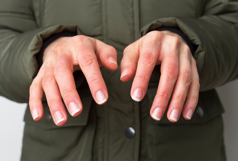 Lưu ngay các dấu hiệu của bỏng lạnh để sơ cứu kịp thời 1