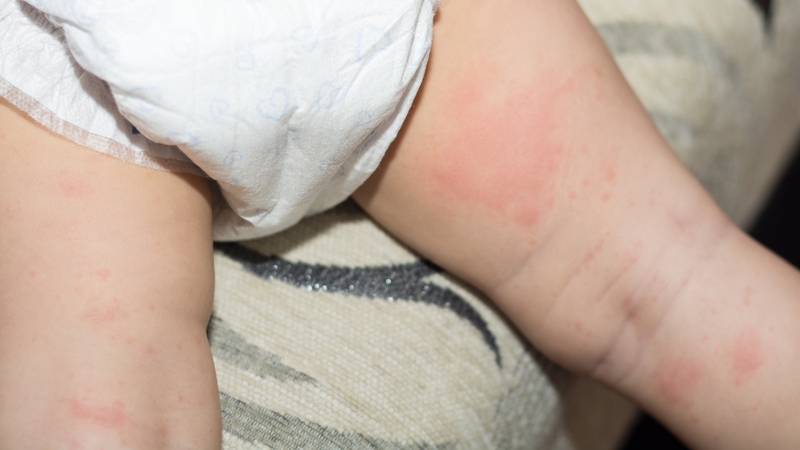 Lưu ý các phản ứng sau tiêm sởi quai bị Rubella 3