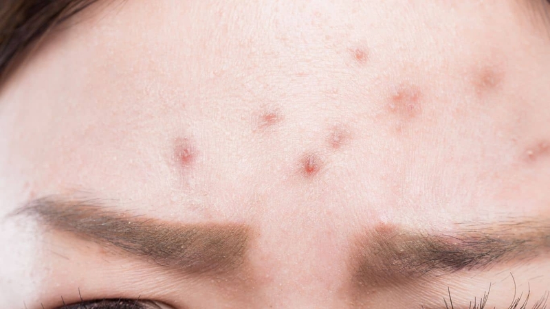 Lưu ý khi điều trị mụn nội tiết ở trán -1