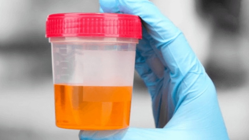 Lý giải hiện tượng sáng ngủ dậy nước tiểu vàng đậm 1