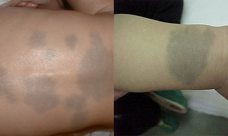 Cách điều trị chàm da xanh ở trẻ sơ sinh 2