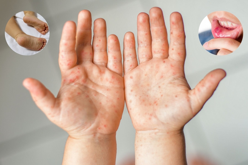 Mã ICD tay chân miệng là gì và những thông tin cần biết về mã ICD tay chân miệng 3