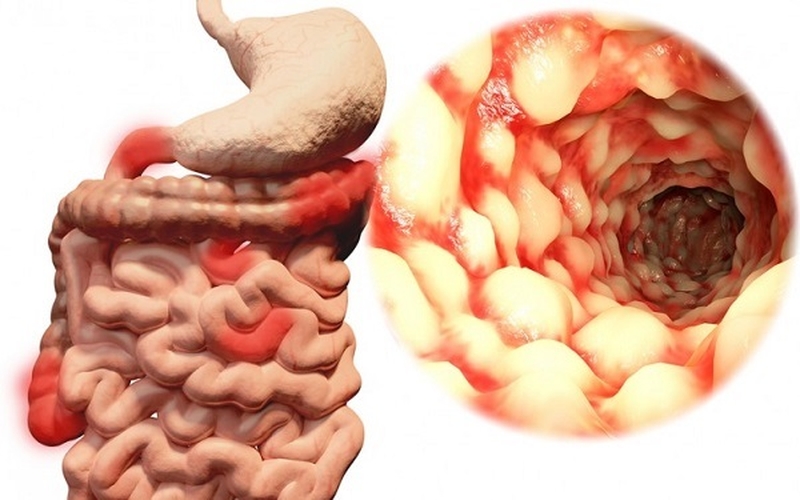 Bệnh Crohn là một bệnh gây viêm ruột và nguyên nhân của nó vẫn chưa được biết rõ