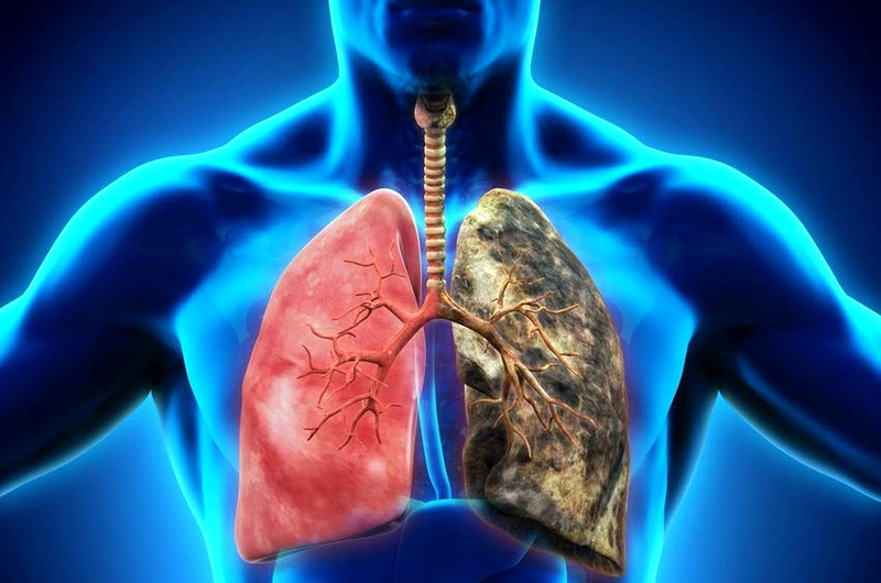 Mắc bệnh ung thư phổi di căn não sống được bao lâu?