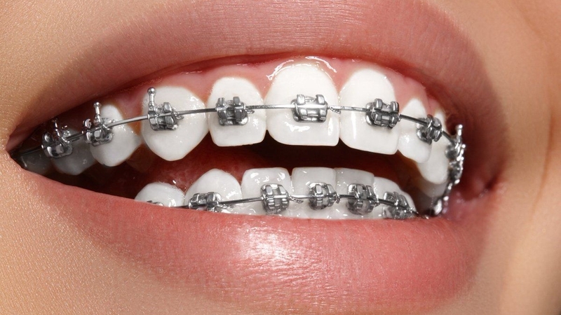 Mắc cài orthoclassic - Mỹ: Giải pháp niềng răng hiện đại và hiệu quả 1