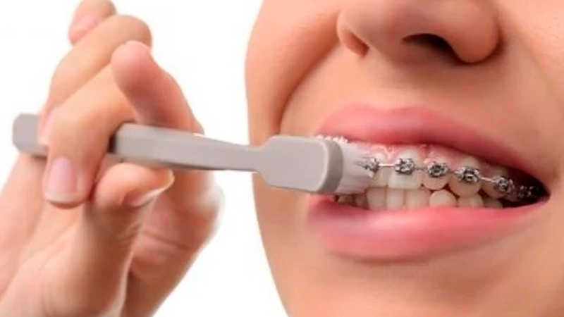 Mắc cài orthoclassic - Mỹ: Giải pháp niềng răng hiện đại và hiệu quả 3