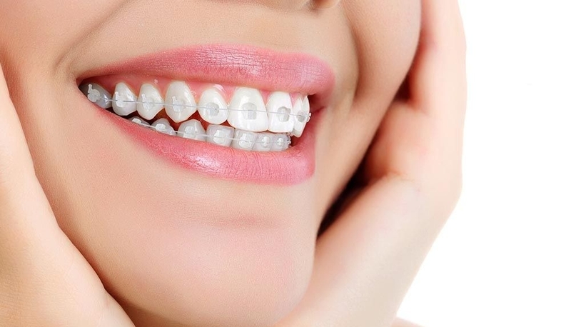 Mắc cài pha lê là gì? Tại sao nên chọn mắc cài pha lê để chỉnh nha? 3