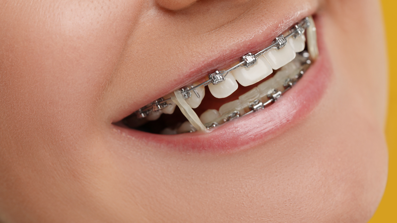 Mắc cài thông minh và mắc cài thường khác nhau như thế nào? 3