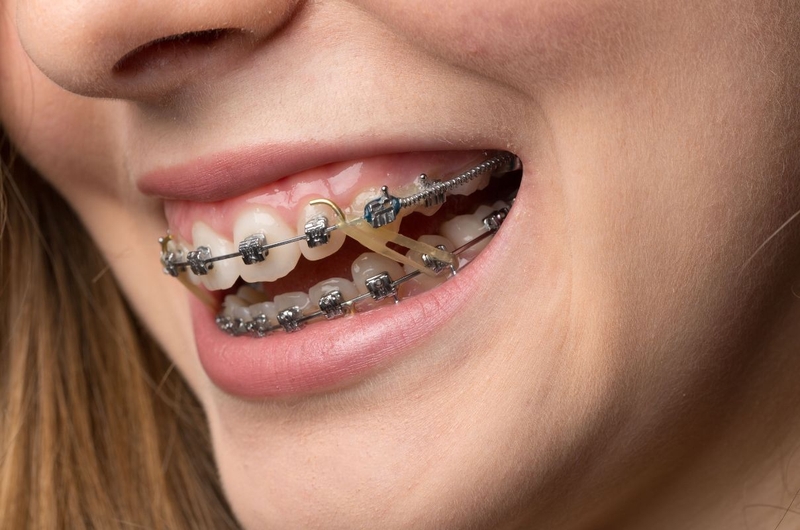 Mắc cài thường có ưu điểm và hạn chế gì? Có nên dùng mắc cài thường không 3