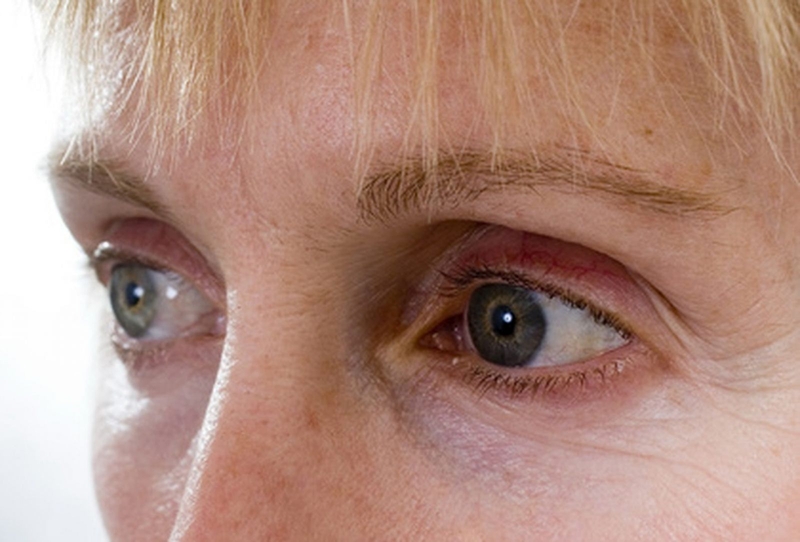 Mắc giả mạc đau mắt đỏ có nguy hiểm không? 1