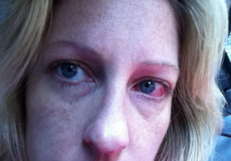 Mắc giả mạc đau mắt đỏ có nguy hiểm không? 3