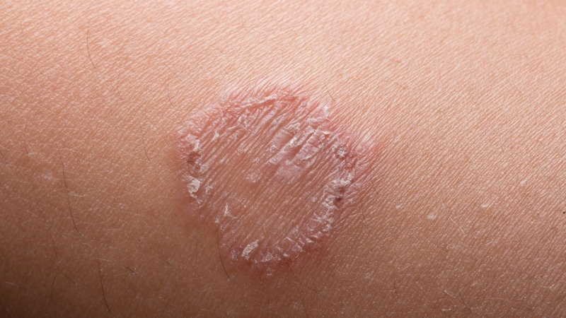 Mách ba mẹ các bài thuốc trị hắc lào ở trẻ sơ sinh đơn giản và hiệu quả 1