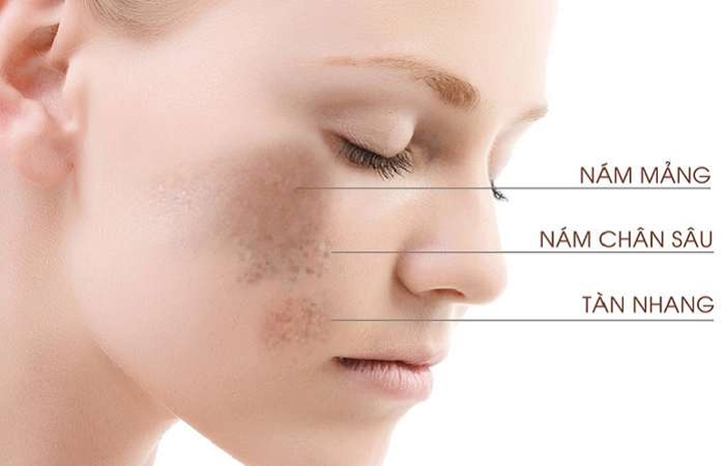 Mách bạn 4 cách trị nám bằng gừng vô cùng đơn giản và tiết kiệm thời gian 1