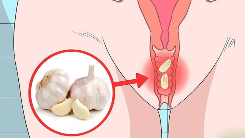Tỏi là một trong những bài thuốc dân gian trị ngứa vùng kín hiệu quả
