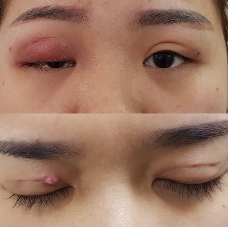 Mách bạn các cách khắc phục mí mắt chảy xệ tại nhà 1