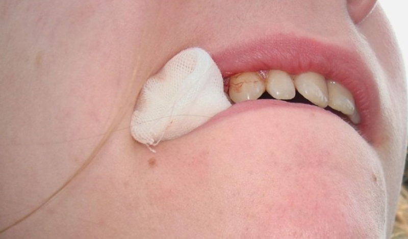 Mách bạn cách chăm sóc răng sau khi trồng implant 2