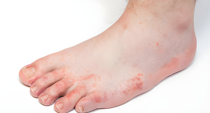 Mách bạn cách phân biệt ghẻ nước và tổ đỉa 2