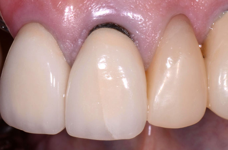 Mách bạn cách trị chân răng bị đen tại nhà dễ làm mà hiệu quả 1