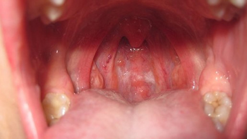 Mách bạn một số cách trị viêm họng hạt tại nhà 1