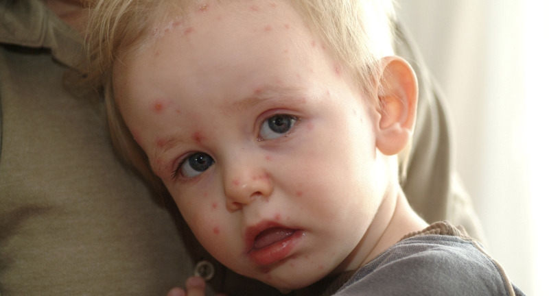 Mách cha mẹ bí quyết chăm sóc trẻ bị thủy đậu