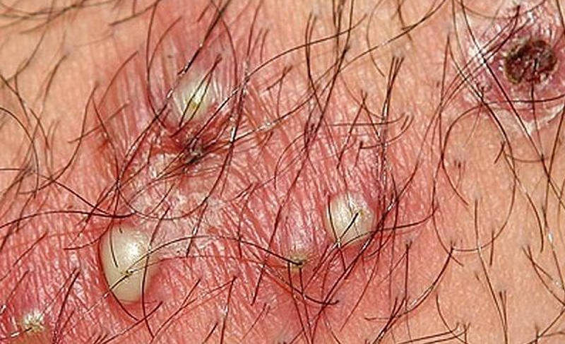 Mách chị em cách chữa đau rát vùng kín tại nhà hiệu quả, an toàn 2