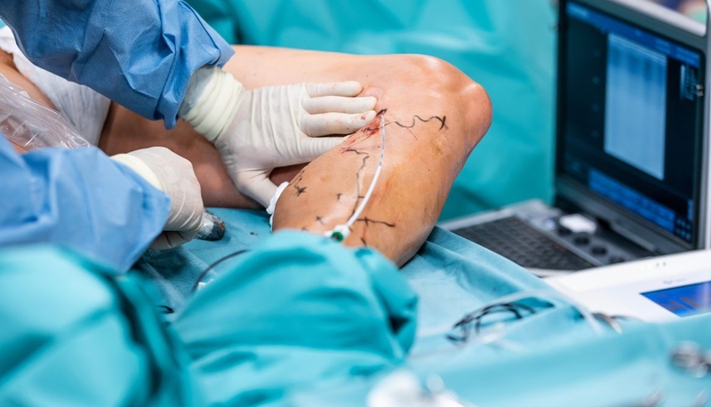 Thông tin cần biết về bệnh mạch máu chi dưới mạn tính 4