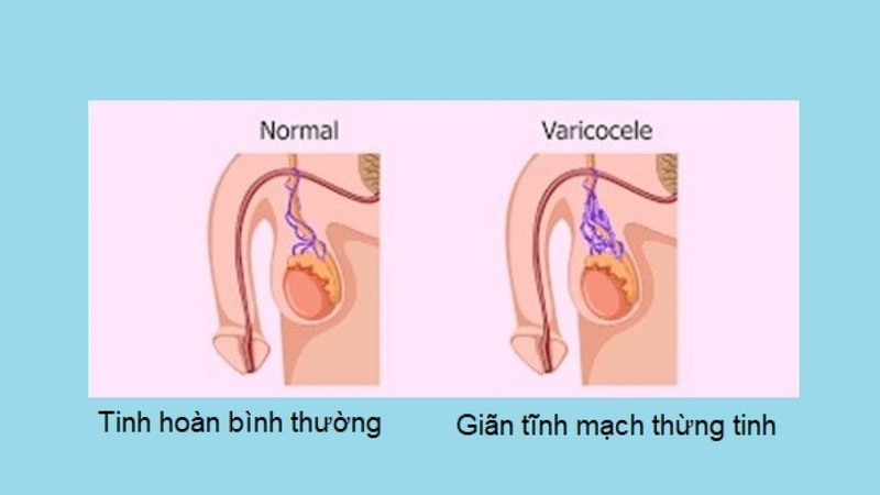 Mạch máu nổi ở tinh hoàn có nguy hiểm không? Phương pháp điều trị hiệu quả 1