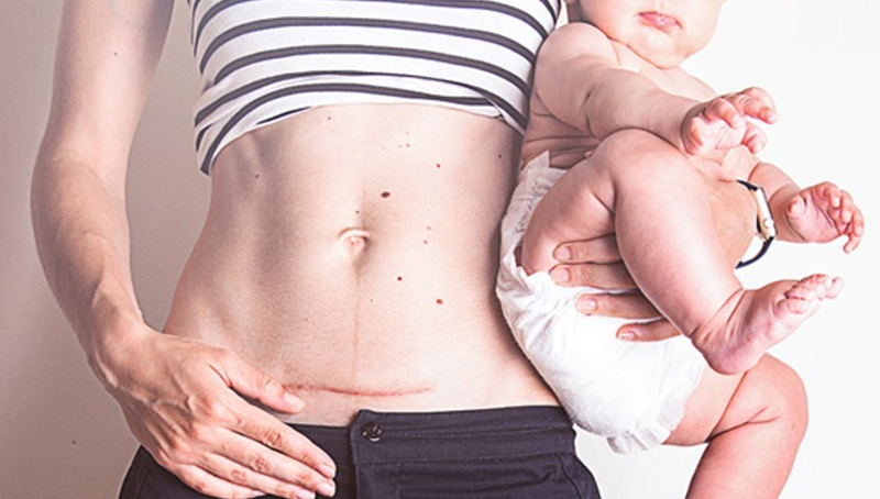 Chăm sóc vết mổ sau sinh giúp tránh để lại sẹo hiệu quả