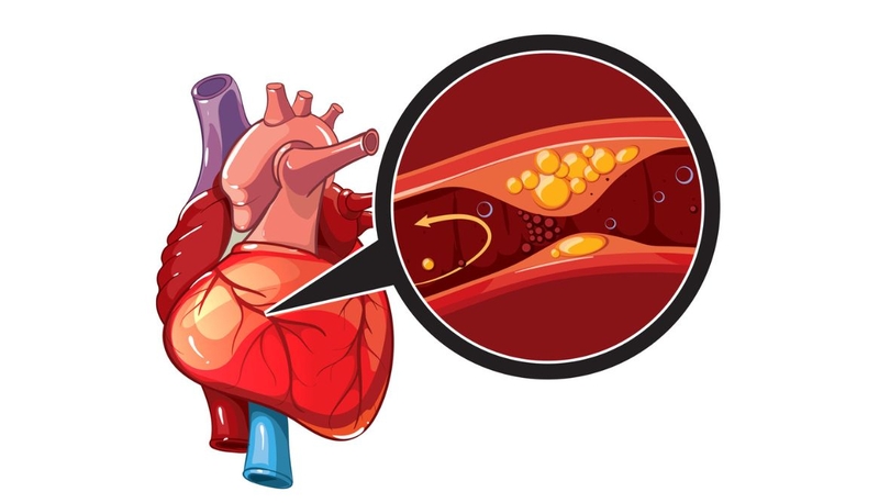 Mạch vành - Hệ thống mạch máu quan trọng và những điều cần biết 3