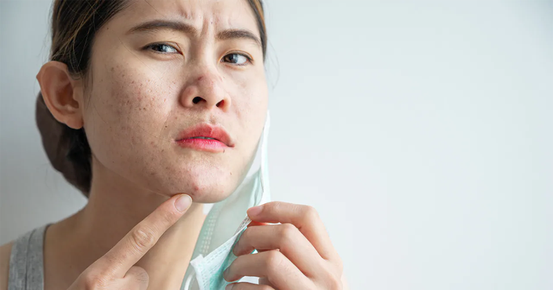 Đeo khẩu trang y tế nhiều có bị nổi mụn không? 2