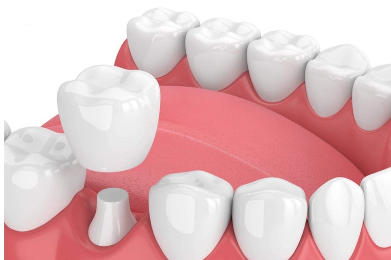 Mài răng bọc răng sứ có tác hại gì không? Cần lưu ý gì? 1