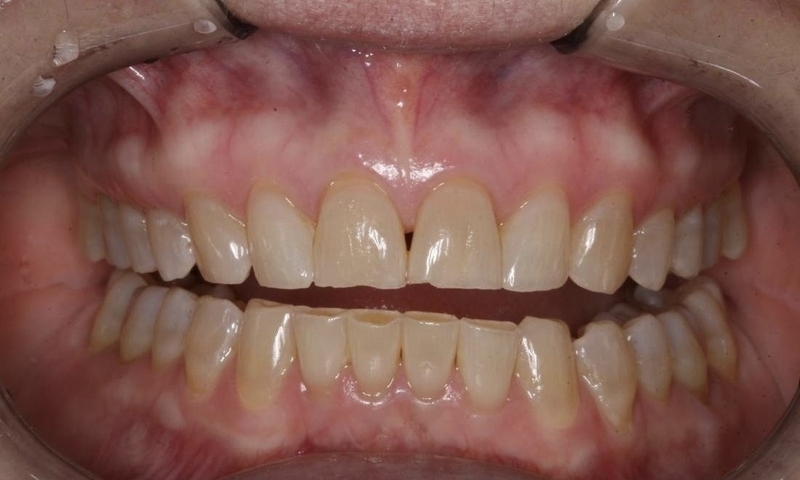 Mài răng đau không? Những điều cần biết về kỹ thuật mài răng trong nha khoa 3