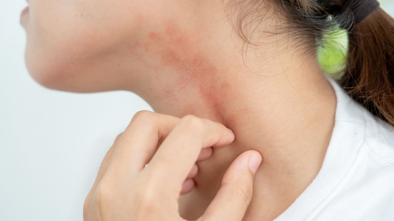 Mẩn ngứa khắp người có thể xuất phát từ dị ứng hoặc bệnh lý tiềm ẩn