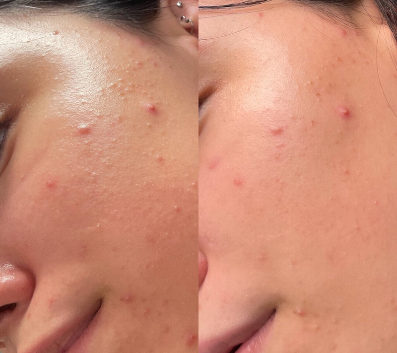 Mandelic Acid có tác dụng gì trong quy trình chăm sóc da? 4