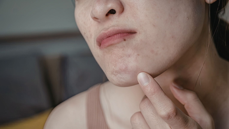 Khi mang thai, thay đổi nội tiết khiến mẹ bầu dễ nổi mụn và nóng trong, nên cần hạn chế đồ cay nóng, nhiều dầu mỡ như bánh tráng nướng