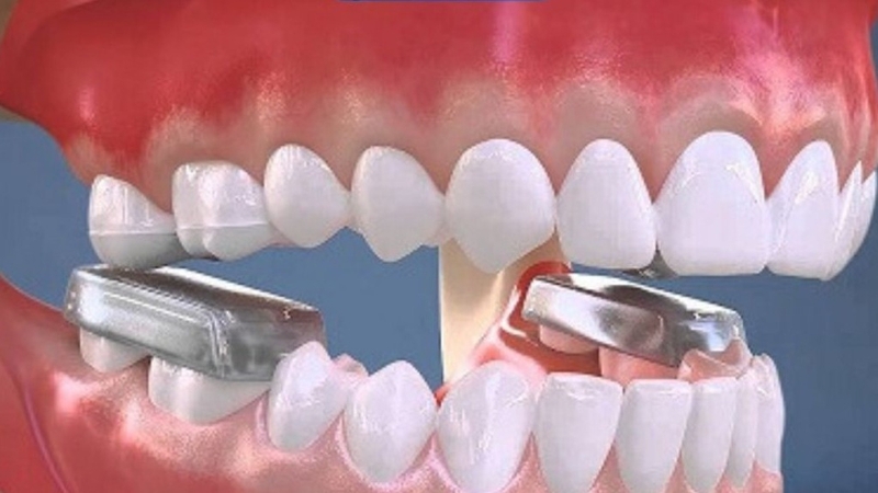 mang-nang-khop-can-la-gi-tac-dung-cua-nang-khop-can-trong-nieng-rang 1.jpg