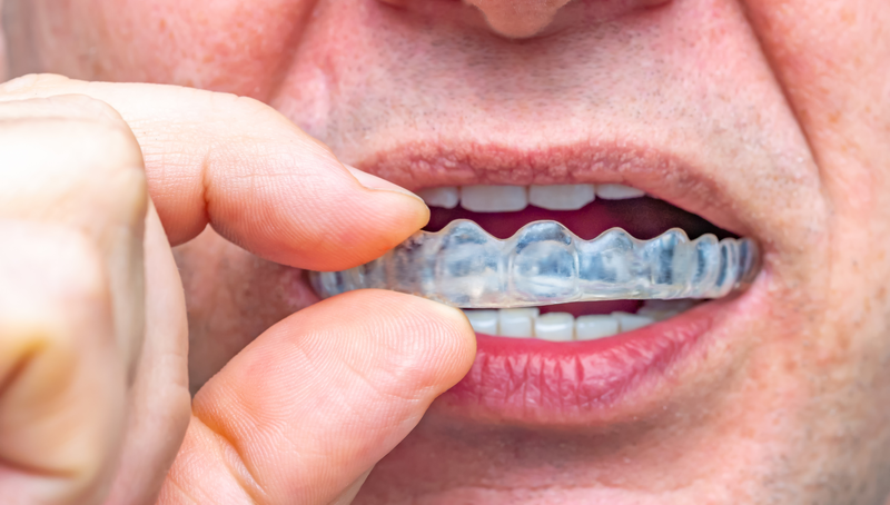 Máng nhai: Giải pháp bảo vệ răng miệng hiệu quả cho mọi lứa tuổi 1