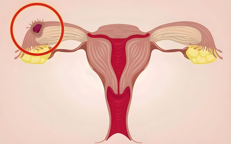 Mang thai 6 tuần ra máu như kinh nguyệt có gây nguy hiểm không? 3