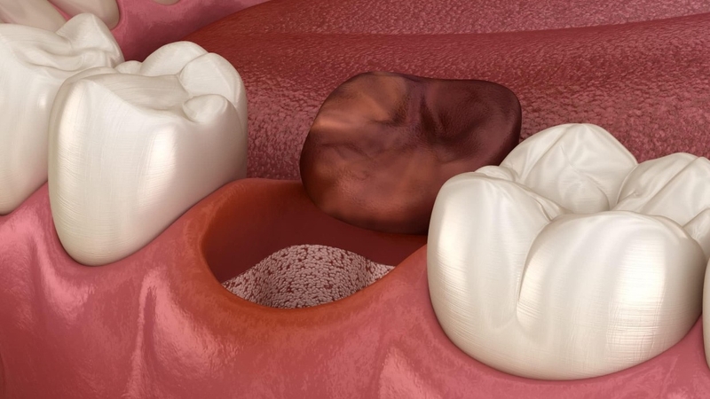 Màng trắng sau khi nhổ răng là do đâu? 1