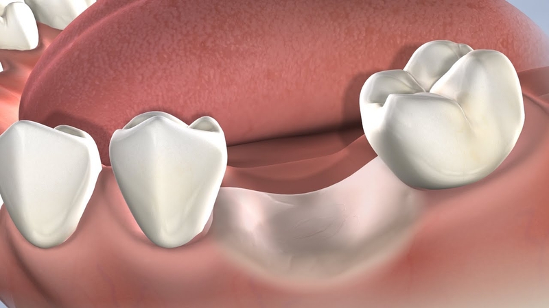 Màng trắng sau khi nhổ răng là do đâu? 2