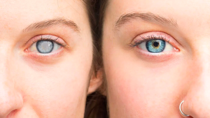 Bệnh màng trước võng mạc là gì? Nguyên nhân, triệu chứng và cách điều trị 4