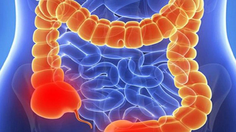 Manh tràng là gì? Các bệnh ở manh tràng thường gặp và cách phòng tránh 5