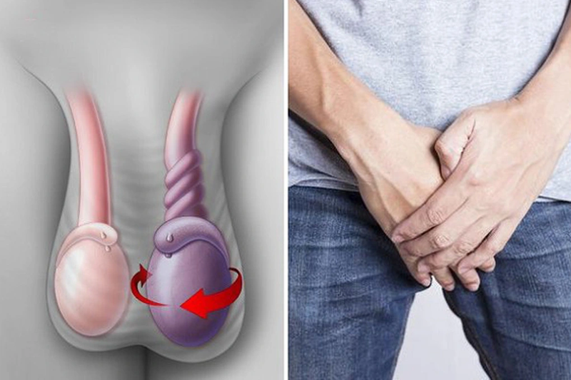 Mào tinh hoàn là gì? Các bệnh lý thường gặp ở mào tinh hoàn 4